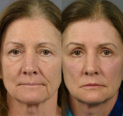 Instant face Tightener No-Filter Primer (with Brush FREE !)